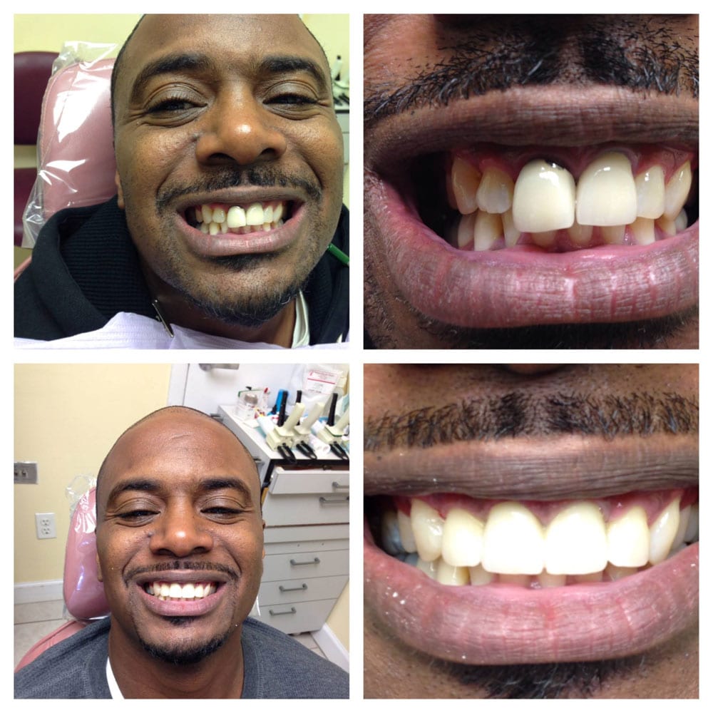 Cosmetic-Dentistry-Makeover-Before-After Before and After Photo