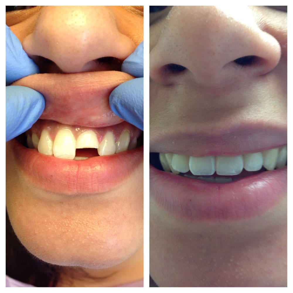 Emergency-Cosmetic-Dentistry-Before-After Before and After Photo