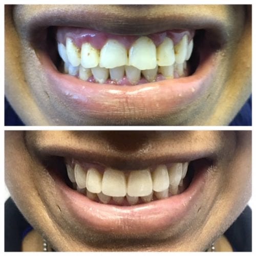 IMG_0250-500x500 Smile Repair Before And After