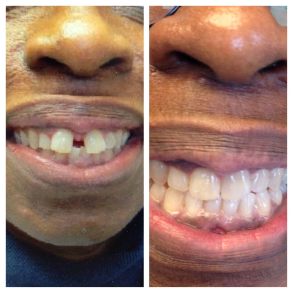 Invisalign-Before-After-Photos Before and After Photo