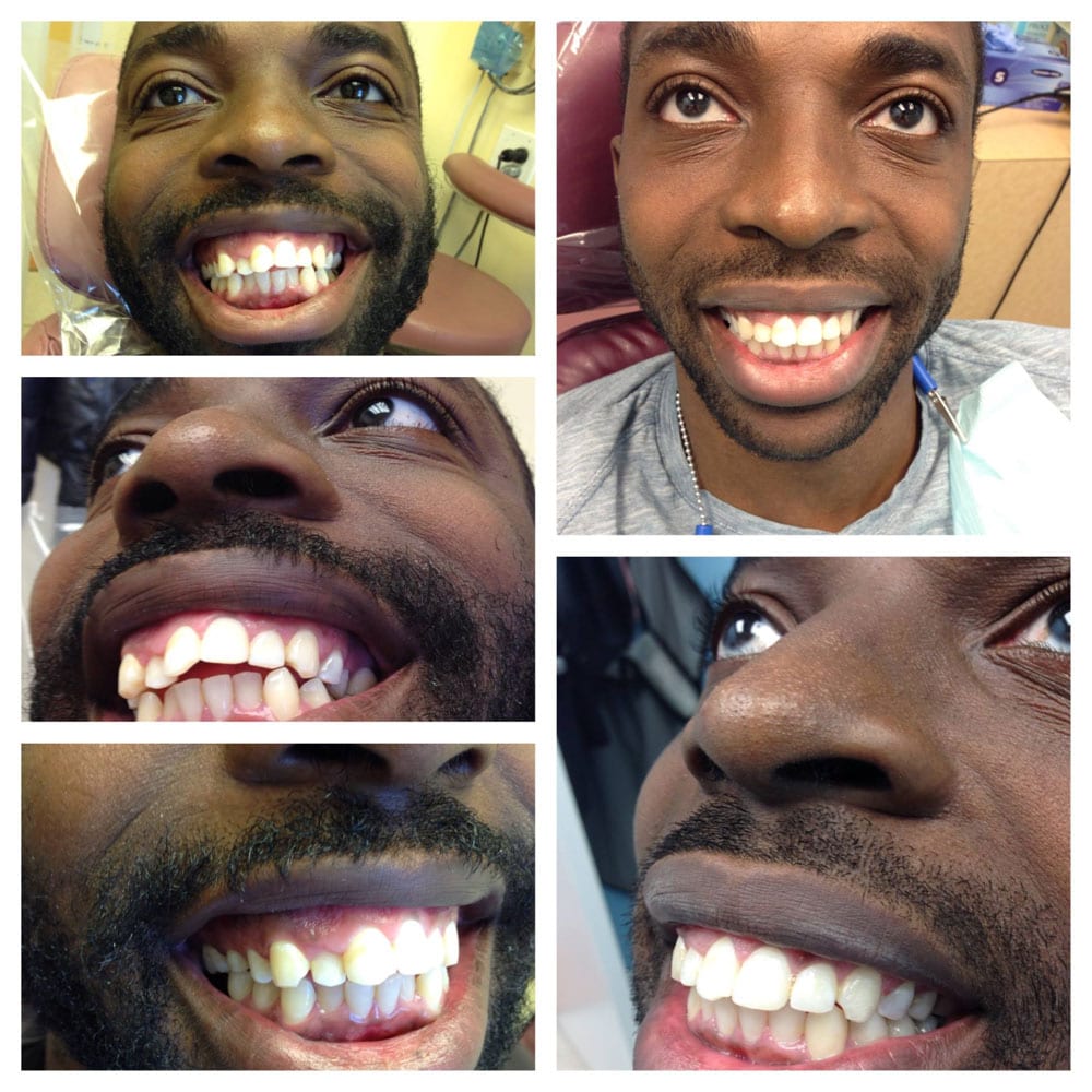 Invisalign-Before-After-Photos2 Before and After Photo