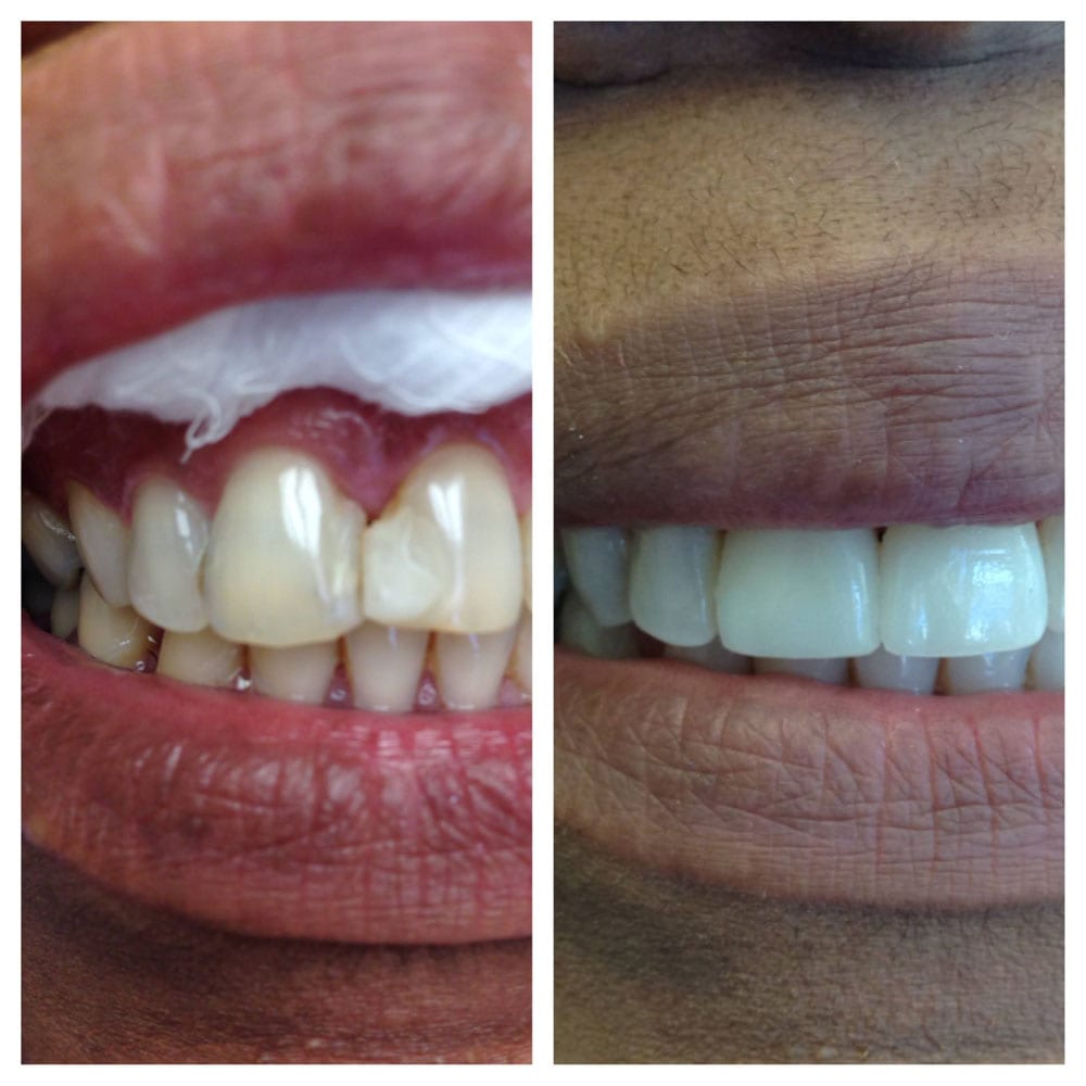 Porcelain-Laminates-Before-After-Photos-5 Before and After Photo