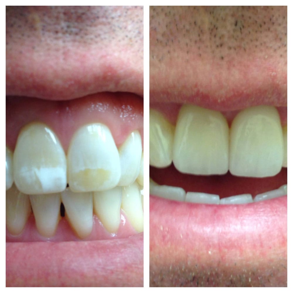Porcelain-Laminates-Before-After-Photos Before and After Photo
