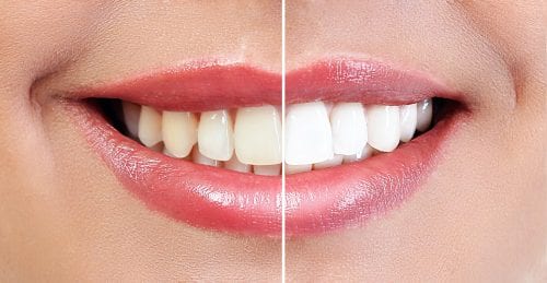 Teeth Whitening Before And After Comparison