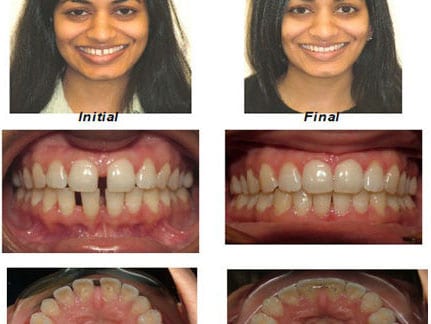 Orthodontics in Dentist in NYC dentistbrooklyn.com Advanced Dental Care Advanced Dental Care of NYC 718-624-1970